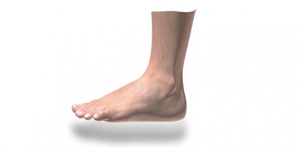 Illustration of foot with red area indicating pain caused by flat feet or collapsed arches